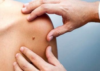 До всесвітнього дня меланоми в Тернополі відбудеться тиждень безкоштовної діагностики родимок