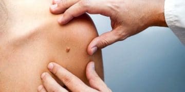 До всесвітнього дня меланоми в Тернополі відбудеться тиждень безкоштовної діагностики родимок