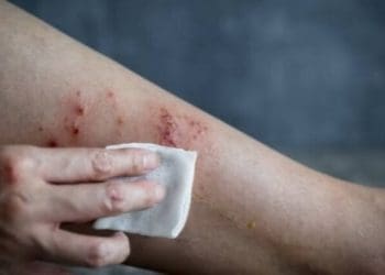 Чи загрожує тернополянам мавпяча віспа