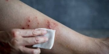 Чи загрожує тернополянам мавпяча віспа