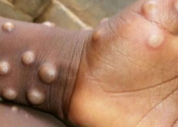 Віспа мавп вже в Україні: у МОЗ повідомили про першого хворого