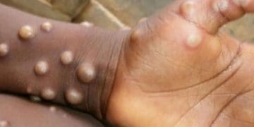 Віспа мавп вже в Україні: у МОЗ повідомили про першого хворого