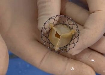 Тернопільські хірурги замінили літньому пацієнту серцевий клапан без розрізу грудини