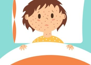 У Чортківській громаді спалах кору – дітей переводять на дистанційне навчання