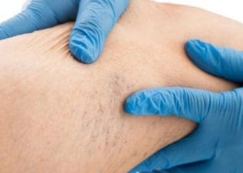 Причини варикозу