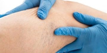 Причини варикозу