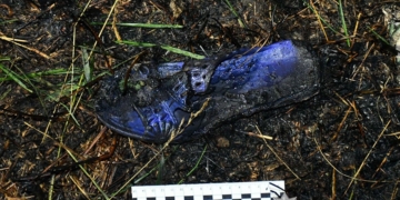 з термічними опіками