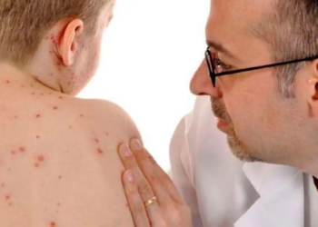 У селах Чортківського району підтвердили спалах кору