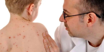 У селах Чортківського району підтвердили спалах кору