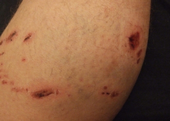 Кривавий Новий рік у Тернополі: 16-річну дівчину покусала знайома після святкування