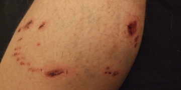 Кривавий Новий рік у Тернополі: 16-річну дівчину покусала знайома після святкування