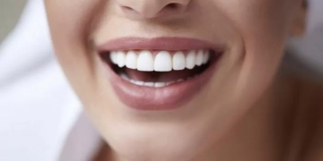 Вініри у сучасній естетичній стоматології: що формує бюджет