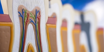 лікування кореневих каналів